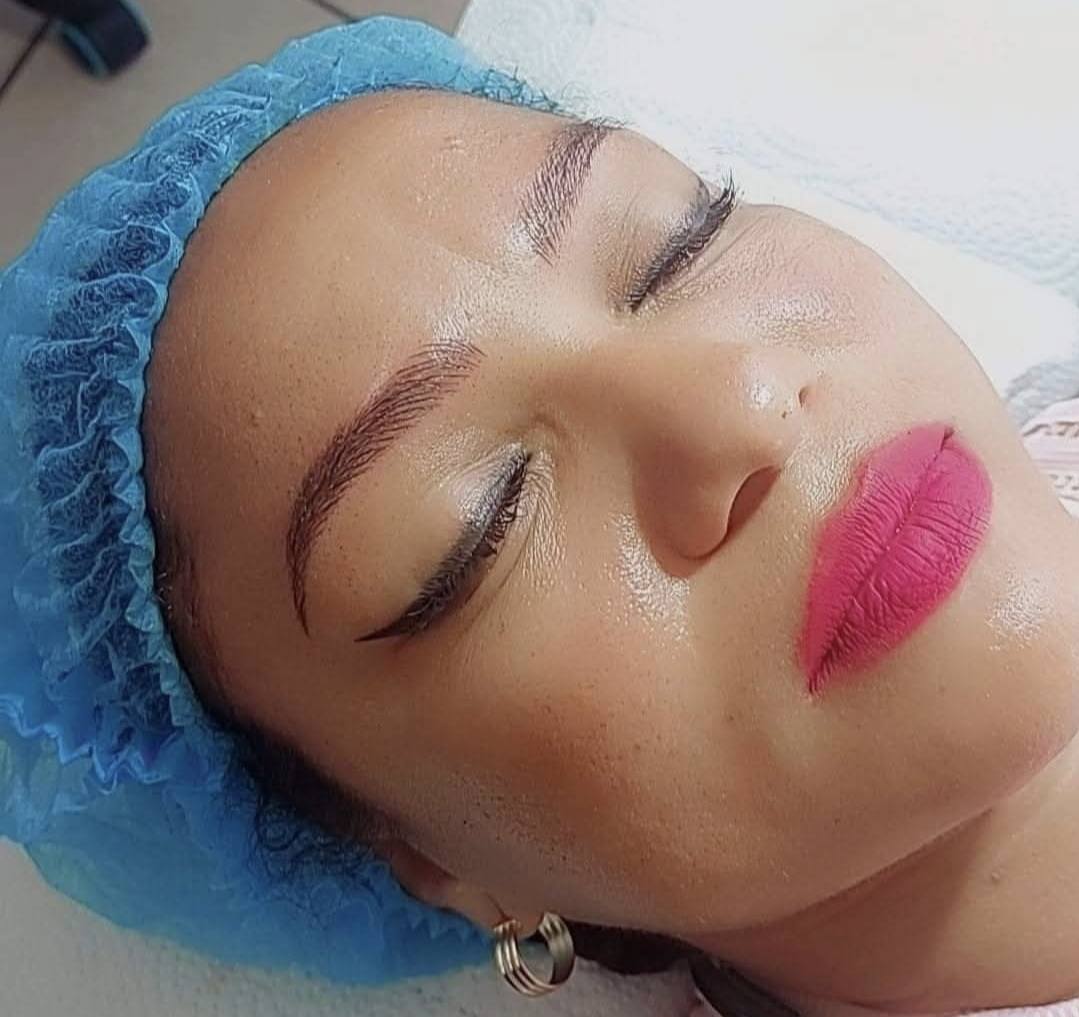 Plasmage eyelid tightening