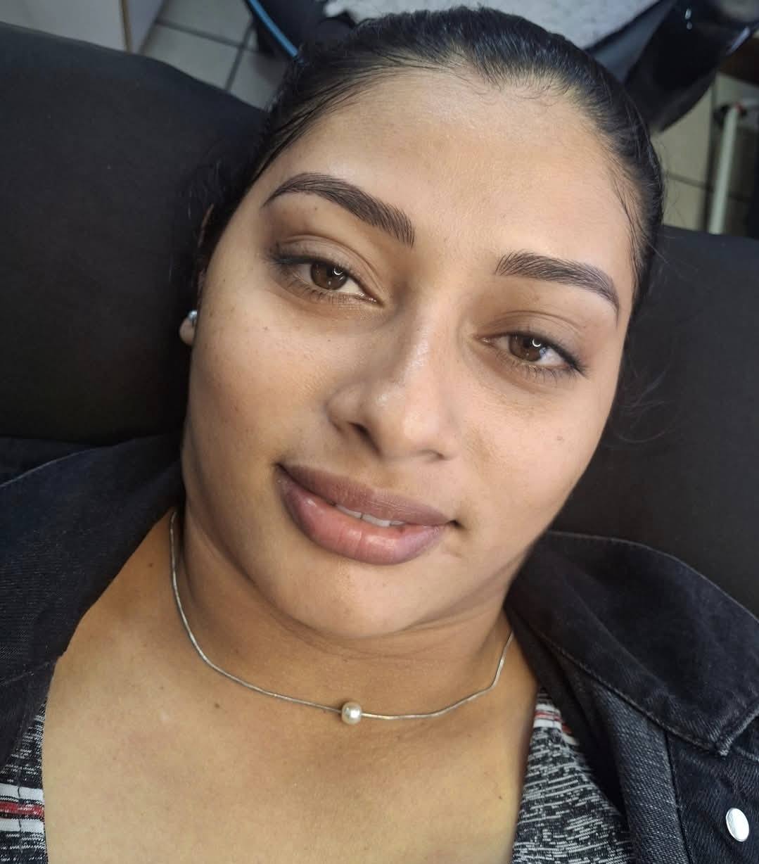 Brow correction healed